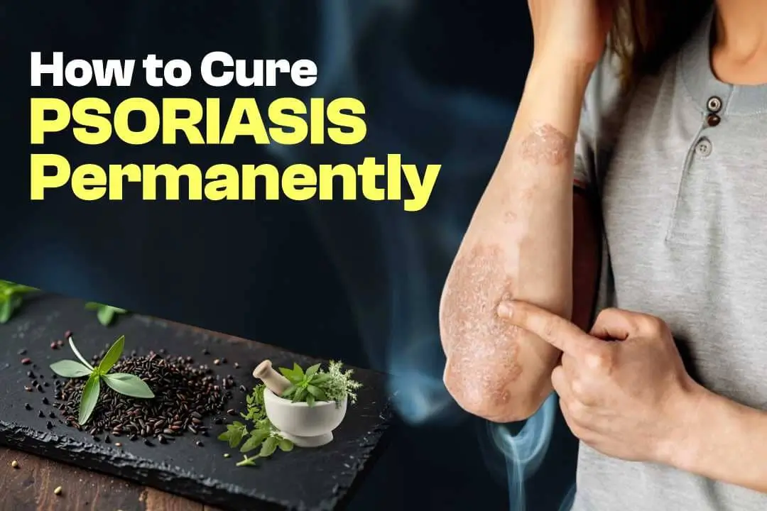 How to Cure Psoriasis Permanently